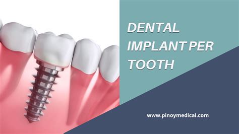 Dental Implant Price Cost per Tooth in the Philippines.